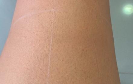 Epilation laser : une solution pour se débarrasser des poils indésirables