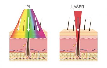 Peut-on faire une épilation laser et partir en  vacances au soleil ?